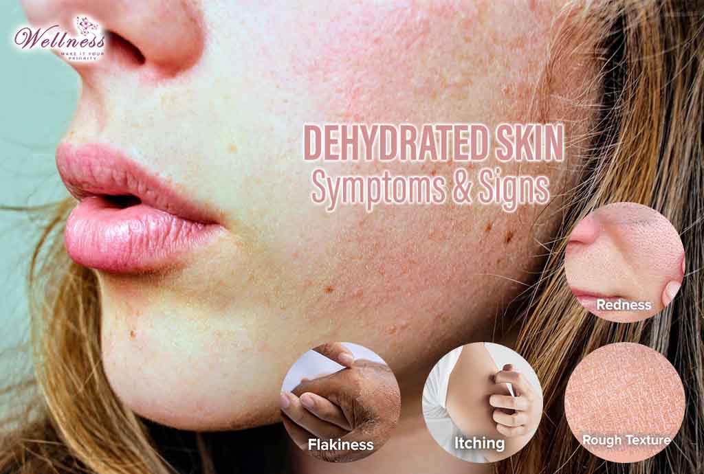 Dehydrated Skin Symptoms and Signs